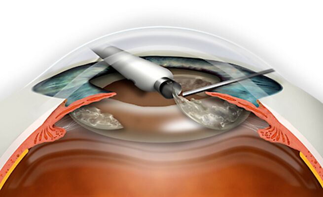 The refractive replacement of the lens is made through micronadle, excluding blood loss