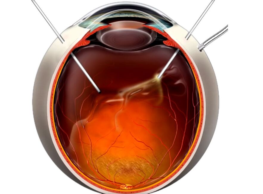 Vitrect surgery surgery